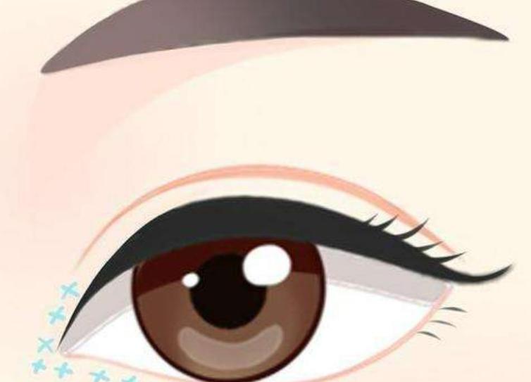 网传的北京吴焱秋双眼皮黑料是假的!警惕同行恶意抹黑,300+修复实例和口碑摆这