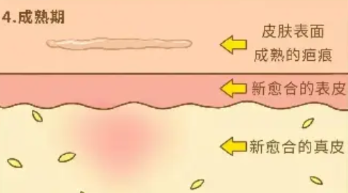 成都美容整形醫(yī)院疤痕科治疤痕好