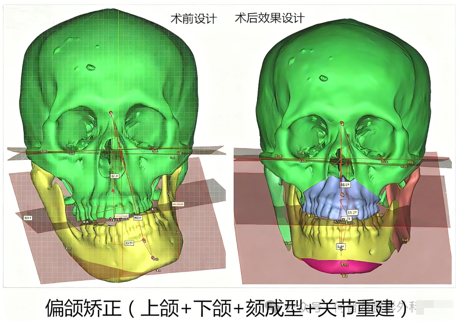 避坑必看！何晋龙正颌价格表：凸嘴6万起，地包天6.2万起，偏颌8万起，双鄂13.6万起，3D打印不瘪嘴