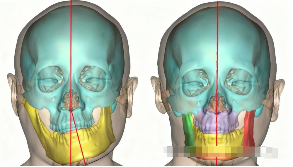 何晋龙正颌手术费用
