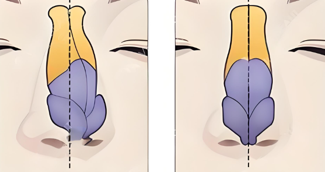 孟庆鹏近20年专注高难度鼻修复