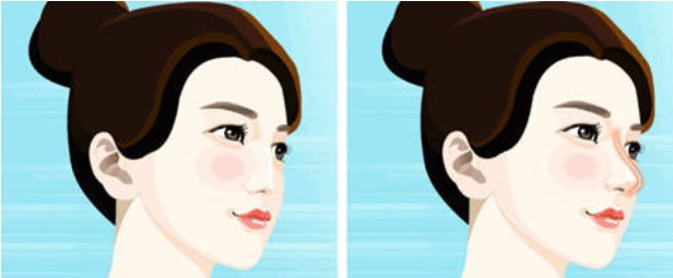 郑州芳艺杨伟做鼻子的真实实例分享