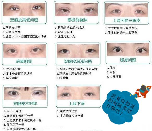 魏志香医生做双眼皮改单眼皮好