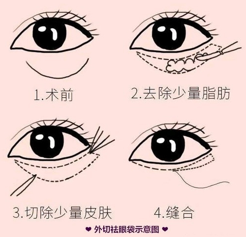 嘉兴内切去眼袋价格