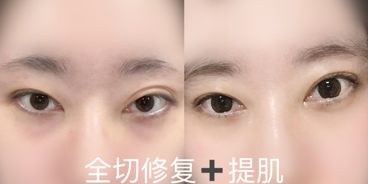 北京吴焱秋魏志香师丽丽谁更好?吴焱秋适合多次失败双眼皮修复,魏志香适合双改单,师丽丽适合妈生眼