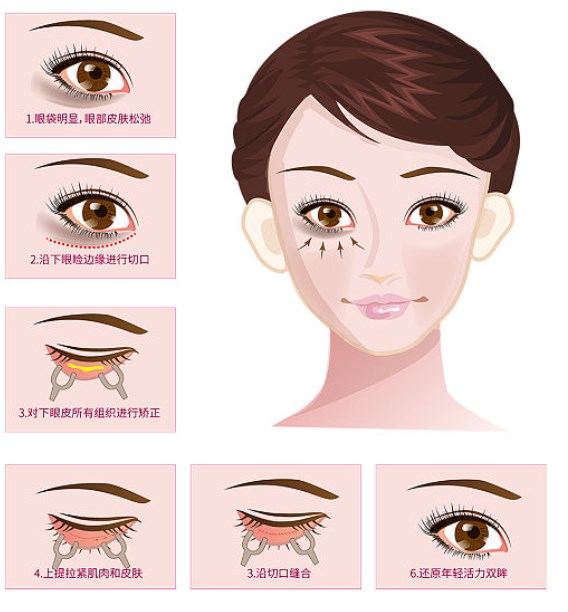嘉兴去眼袋真实实例对比：不同机构疗效有何差异？