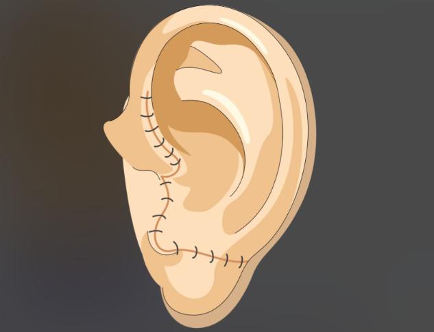 郭志华和郭树忠小耳再造哪个好?技术流派大不同!郭树忠自体肋软骨雕刻是一绝,郭志华生物支架一次成型创伤更小!