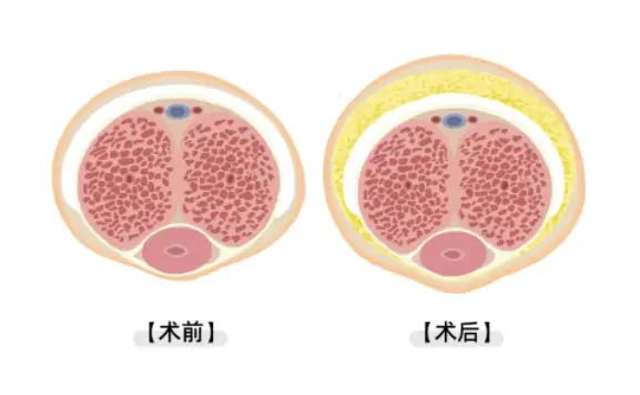 刘蒙医生男性私密整形靠谱吗？从3个月术后真实变化看疗效