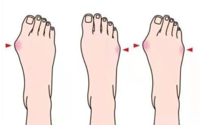 苏敬达做拇外翻一只脚什么价格？单脚8000-12000元亲测合理，附重度微创疗效真实反馈