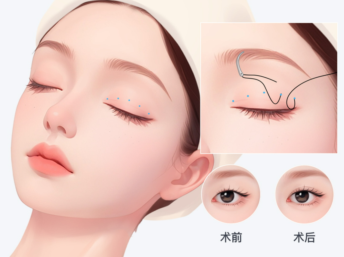 放心冲！上海曾翾博士修复眼睛价位：IFM法内眼角修复4.5万起，肉条眼修复5.8万起，宽改窄3.5万起，德媛医疗可约