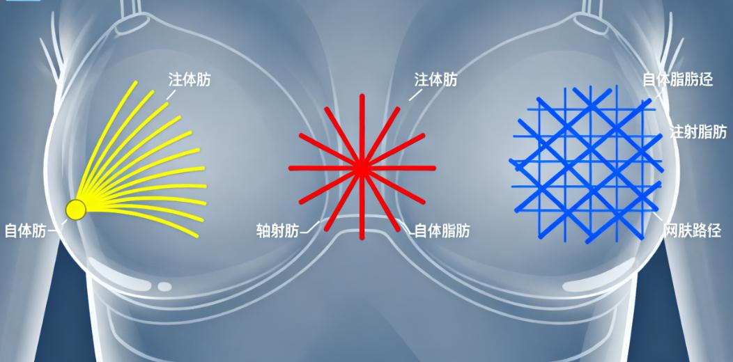 王明利自体脂肪隆胸什么价位?亲测39000元起做360cc,形态自然手感柔软