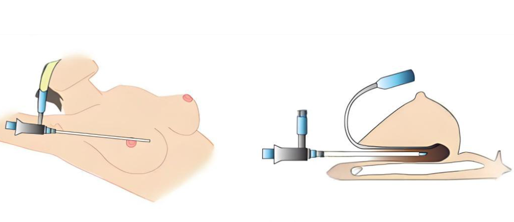   南京华美裴旭芳隆胸成效如何？从切口到形态，细节控可闭眼入