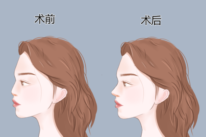 宁波艺星隆鼻成效