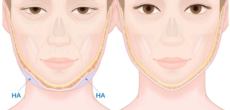 陈建忠拉皮成效