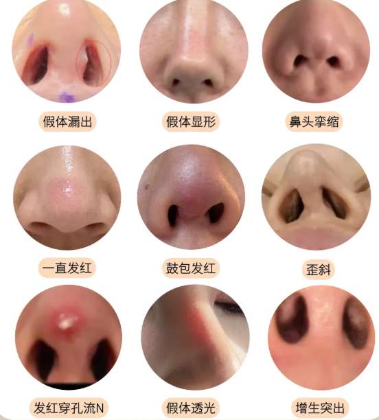 北京蒋亚楠鼻子修复的价格参考：影响费用的3个核心因素
