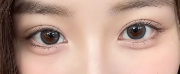 刘晓荣双眼皮修复怎么样?术后半年反馈,自然度、对称性、疤痕情况实测