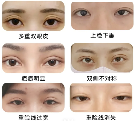 刘晓荣双眼皮修复怎么样?