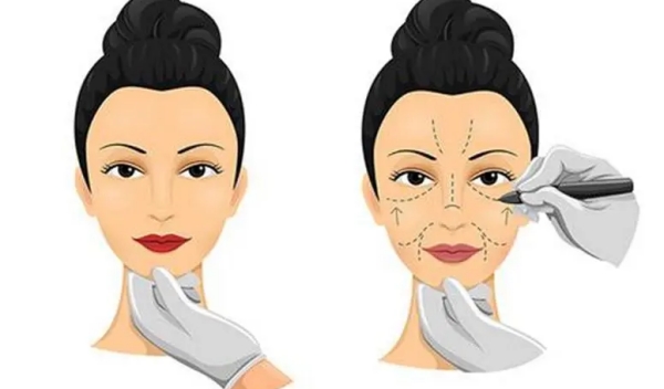 深圳非凡双眼皮医生