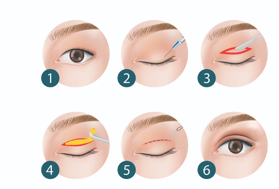 如何在深圳非凡整形医院选择适合自己的双眼皮医生