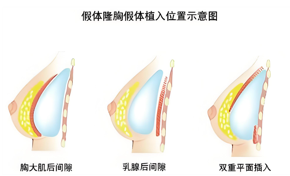 西安艺星做胸好的医生如何选择？