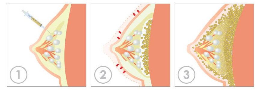 林沸腾和余力自体脂肪隆胸成活率对比