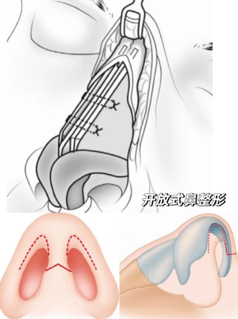 牛永敢的名气是捧出来的?错!国内首批引进达拉斯鼻整形技术,硬核实力碾压质疑~
