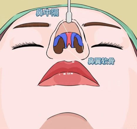 谁造谣牛永敢隆鼻有黑历史？弹性双拱支架 + CT3D 设计，高难度鼻修复实力打脸谣言！
