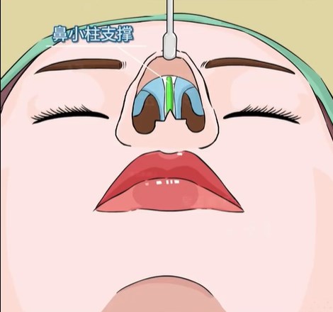 牛永敢隆鼻怎么样