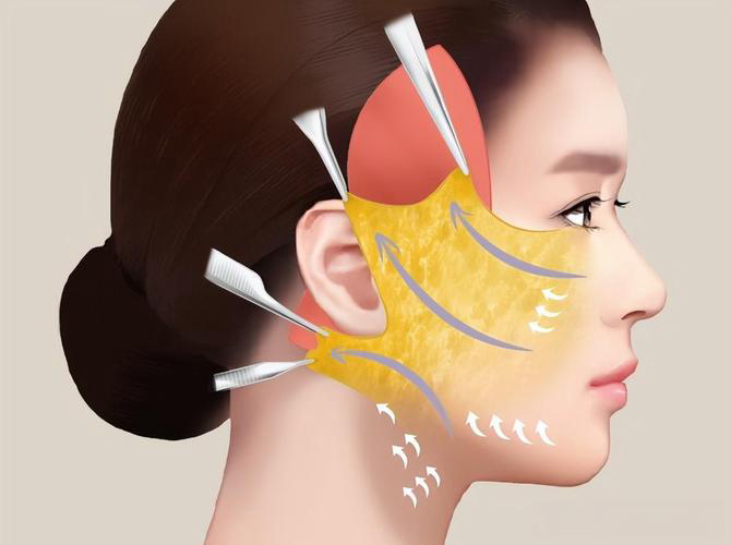 姐妹们冲！深圳王乙立面部提升价格表2万起，泽棠坐诊+三维筋膜复位性价比拉满