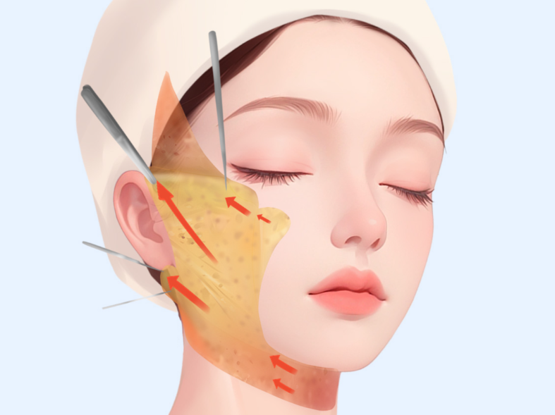 深圳王乙立面部提升一般多少钱