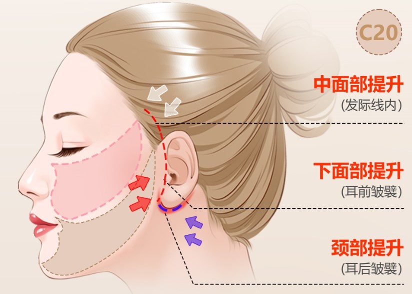 深圳王乙立面部提升价格表贵吗