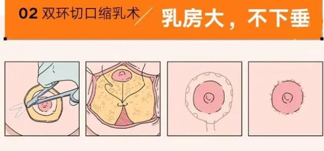 南京朱淼医生缩胸的价格：8k-1.5w明明白白，无隐形消费