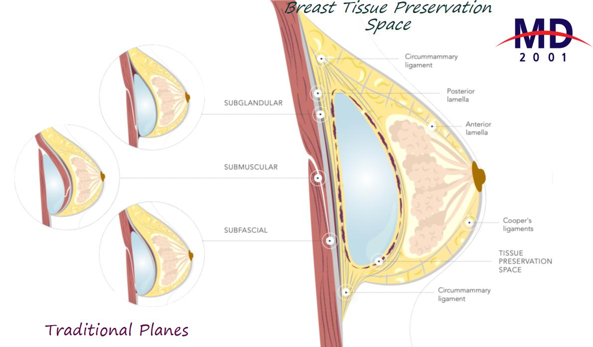 杭州凯丽 KSA 丰胸技术介绍