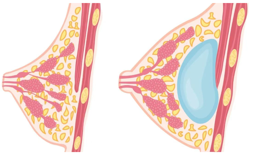 凯丽KSA丰胸技术核心逻辑:分层填充原理与临床应用