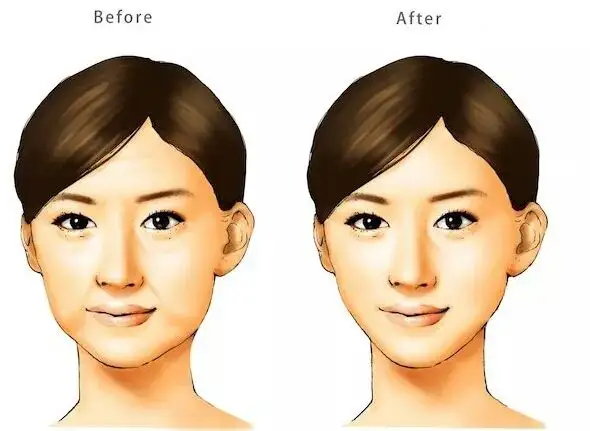 北京木偶纹治疗选择要点