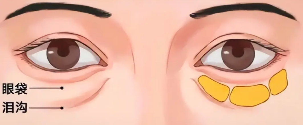郑州眼袋修复王杨医生简介