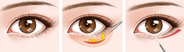 郑州眼袋修复王杨医生怎么样