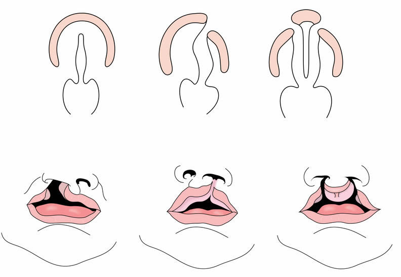 唇腭裂线上问诊24小时免费问诊