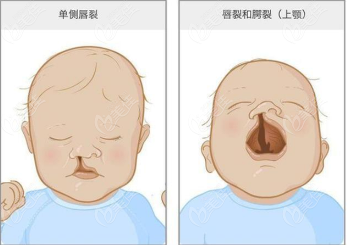 唇裂线上问诊24小时免费