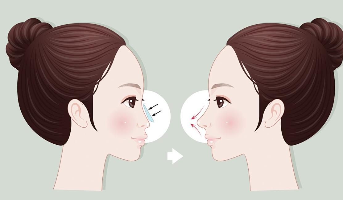 二、尹剑鼻修复手术的五大技术优势解析www.aimei.com