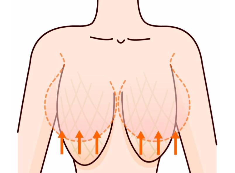 無(wú)錫李建東維維提升跟乳房懸吊一樣嗎？完全不同！微創(chuàng) 1.5cm 切口，李建東維維提升更靠譜！