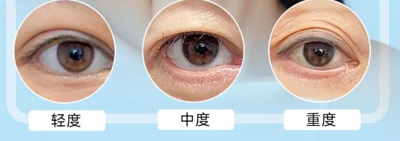 李月辉修复眼睑外翻真的这么腻害吗