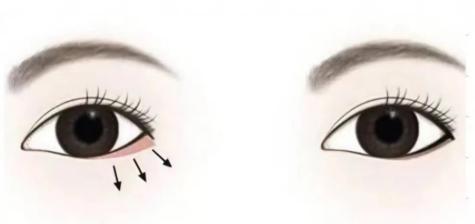 李月辉修复眼睑外翻真的这么腻害吗？真实实例分享，术后3个月自然度提升明显