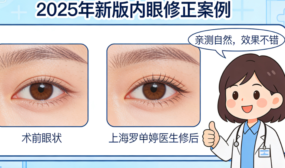 罗文婷医生2025年内眼角修复实例解析