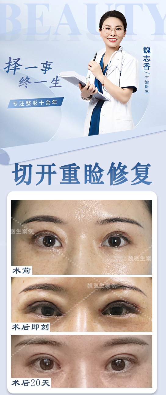 成都成美整形费用贵吗?双眼皮1.2万起,隆鼻2.5万起,价格透明不踩坑