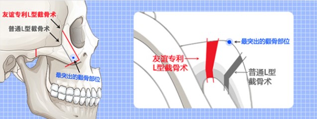 南宁打下颚线哪家医院好?亲姐刚做了,说华美医生会设计、爱思特针剂保真,比小诊所放心多了