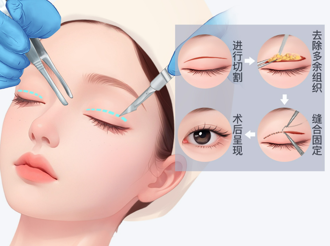 石家庄爱尚美何晓娅双眼皮真实实例解析:3种眼型的改善疗效