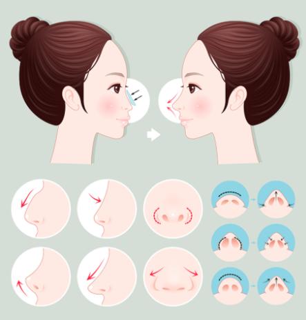   穆宝安V美提升技术解析