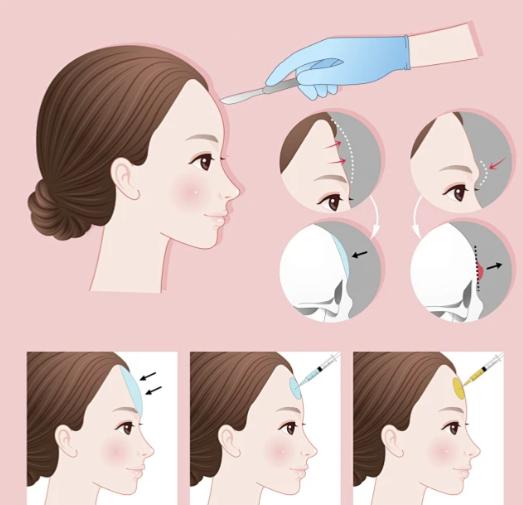 王志军传统拉皮：重度松弛者的“经典选择”，优势与局限并存