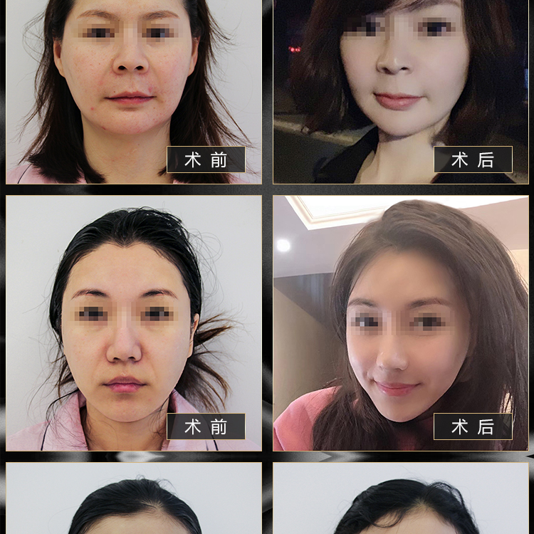 穆宝安和王志军拉皮谁好？他俩做面部拉皮各所长：穆宝安v美提升自然，王志军传统拉皮也能打